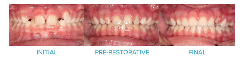 Restoring Small Upper Lateral Incisors