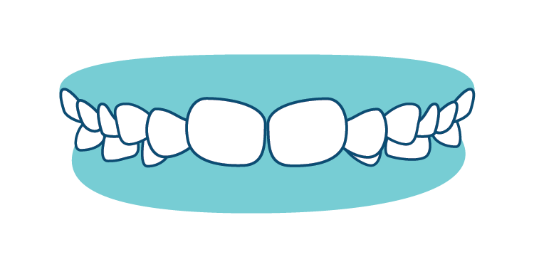 Teeth-Phase I Bite Problems-02