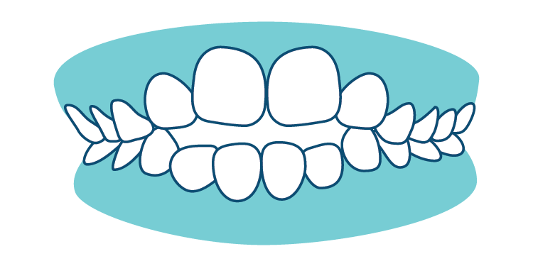 Teeth-Phase I Bite Problems-03